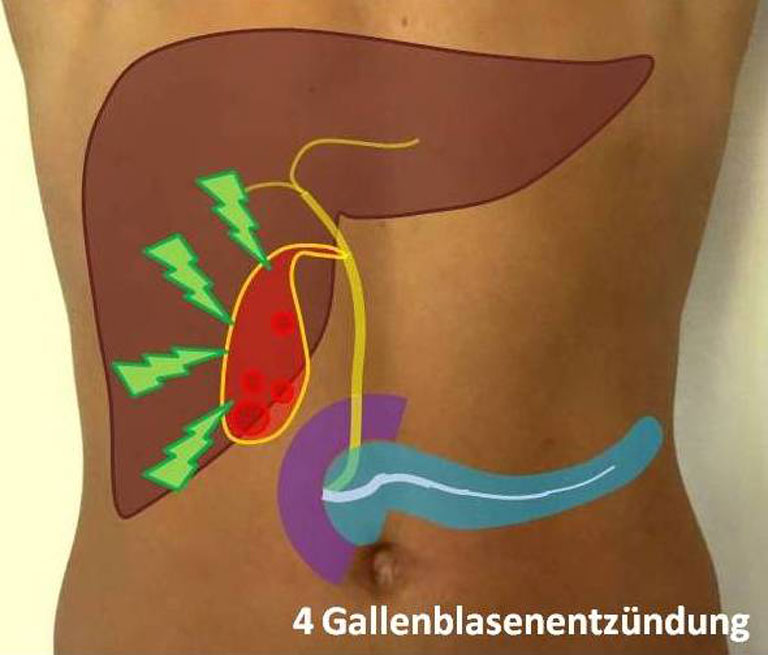 Op schmerzen seite rechte gallen nach Gallenschmerzen