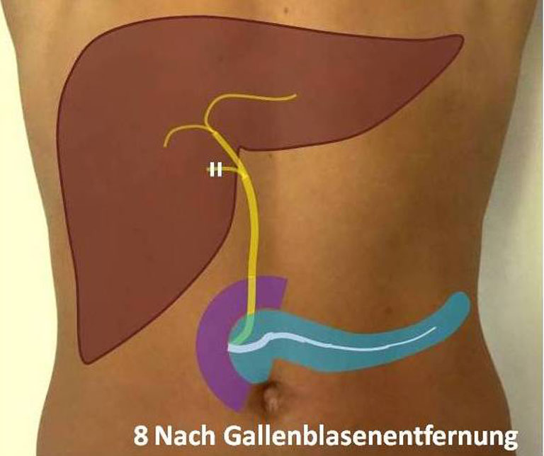 Wie lange krank nach gallen op