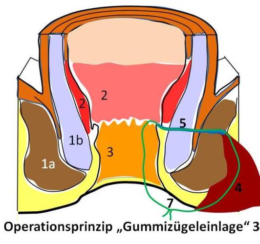 Knoten an äußerer schamlippe