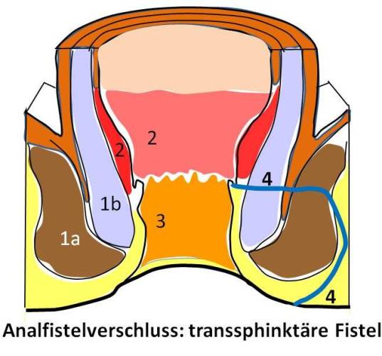 Rektovaginale Und Rektourethrale Fistel XNCUC Rektovaginale Und Rektourethrale Fistel XNCUC