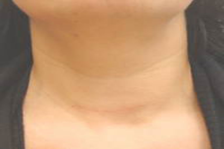2: Hals mit einer verheilten Narbe nach einer Schilddrüsenoperation.