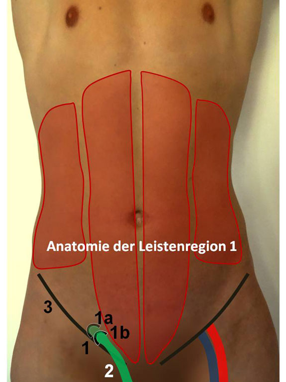 Leistenbruch OP in Nürnberg