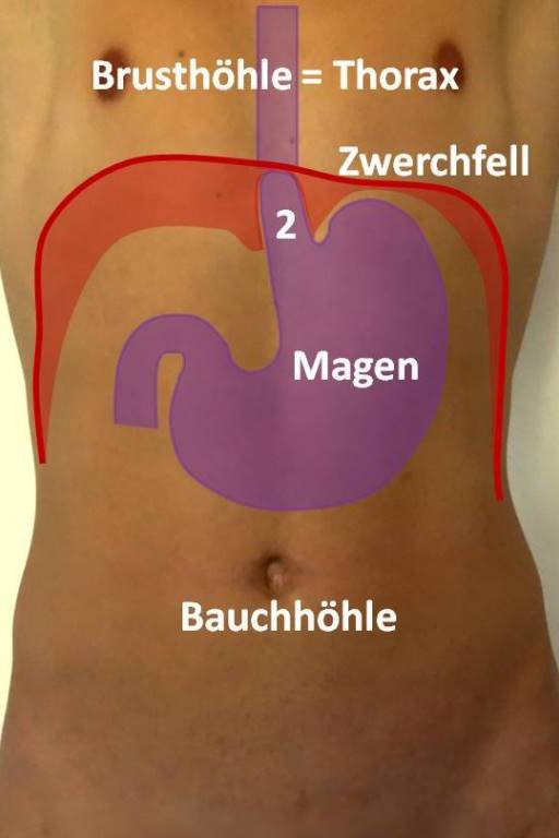 Lange krank zwerchfellbruch op wie Großen Zwerchfellbruch